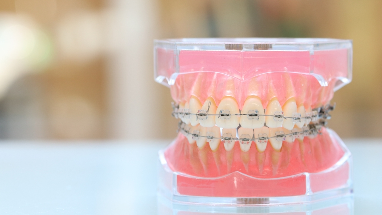 ワイヤー矯正について詳しく解説するページへのリンク