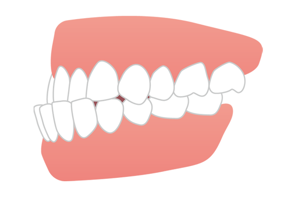 下の歯が上の歯より前に出た受け口・しゃくれ（反対咬合・下顎前突）のイラスト