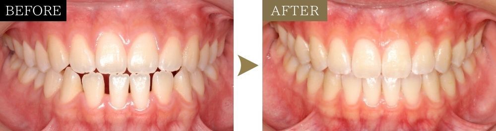すきっ歯の治療前後比較写真（正面）