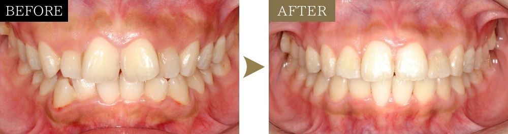 前歯の乱れの治療前後比較写真（正面）