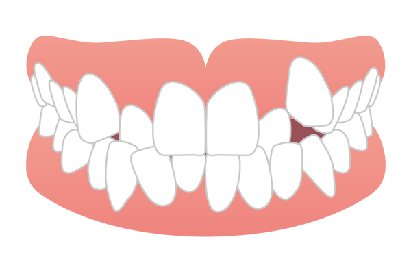 歯が重なり合うように生えた叢生・乱杭歯（ガチャ歯）のイラスト