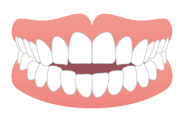 前歯がしっかり噛み合わない開咬（オープンバイト）のイラスト