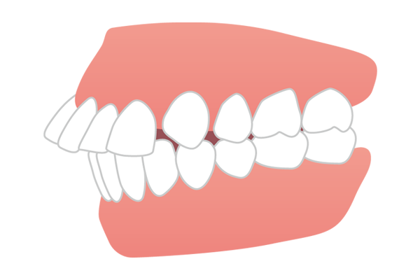 上の前歯が大きく突き出ている出っ歯（上顎前突）のイラスト