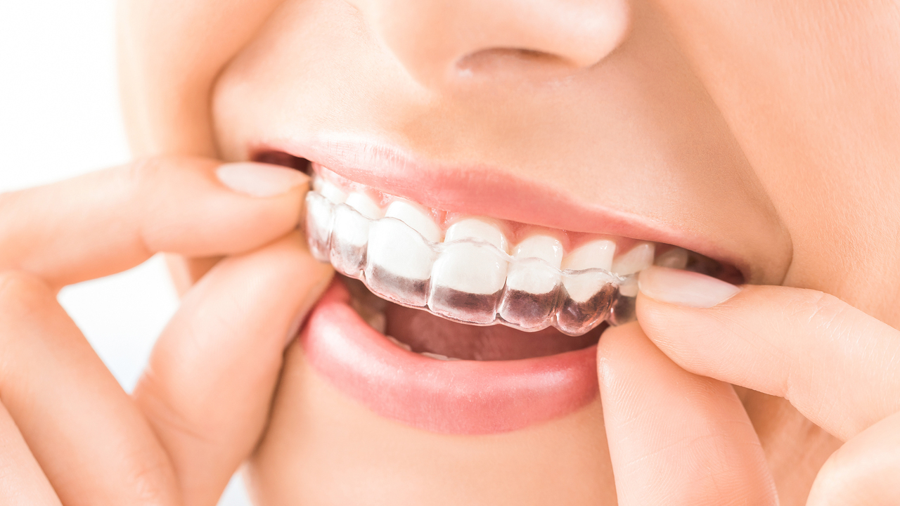 前歯と奥歯を総合的に治療できるマウスピース装置