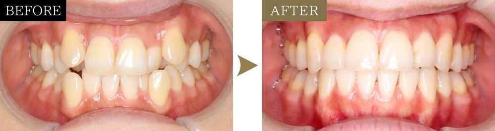 八重歯・ガタガタの治療前後比較写真（正面）