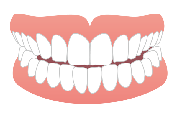 上下の前歯の先端同士がぶつかる切端咬合のイラスト