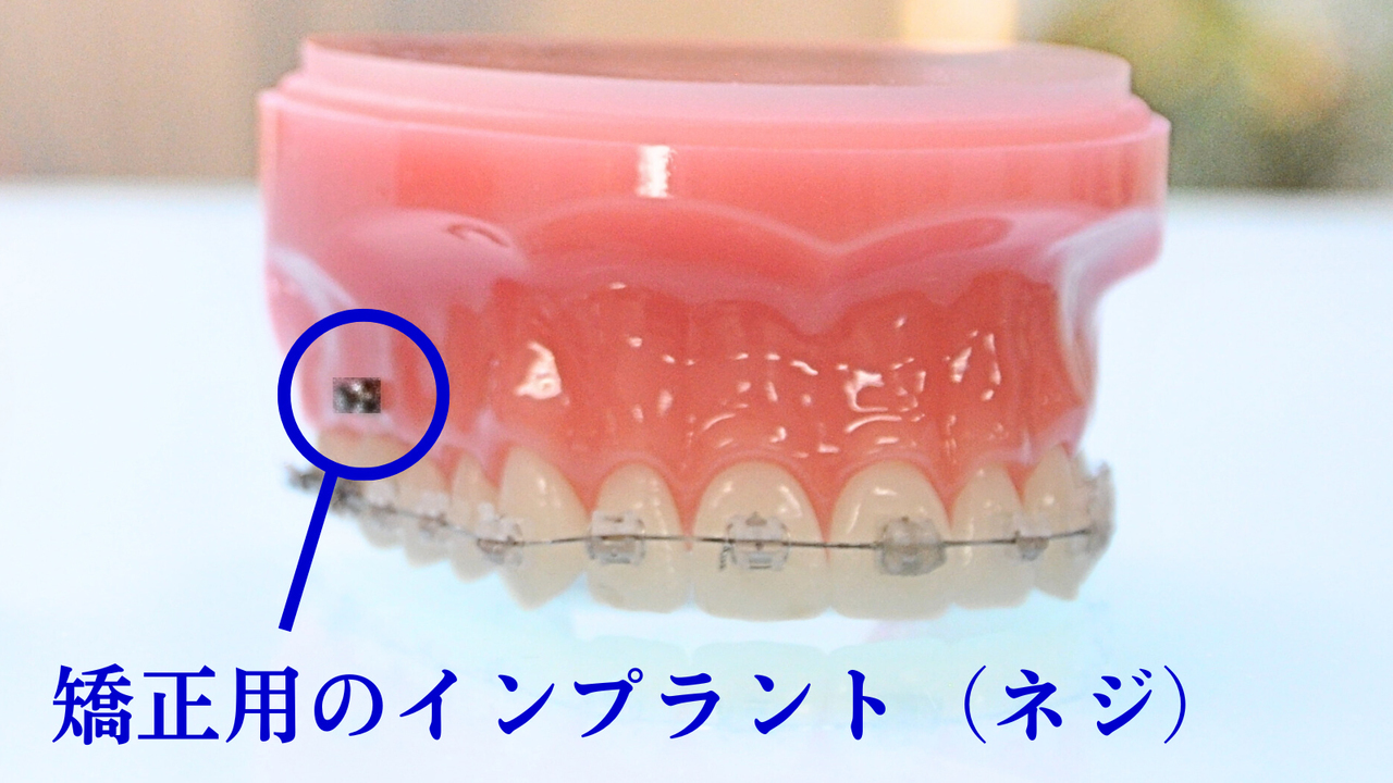 インプラント矯正について詳しく解説するページへのリンク