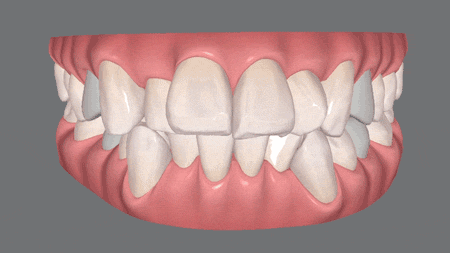 矯正前後の歯並びの変化がわかるシミュレーション画像